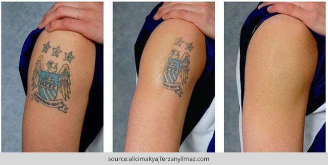 How To Remove A Permanent Tattoo: DIY Methods and Surgical ...
