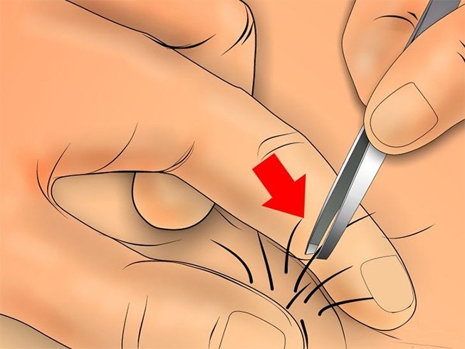 How To Get Rid Of Ingrown Hair In 5 Easy Ways Sans Pain And Pinches