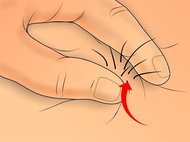 How To Get Rid Of Ingrown Hair In 5 Easy Ways Sans Pain And Pinches