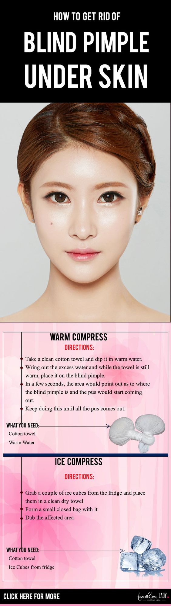 how to get rid of a pimple fast under the skin
