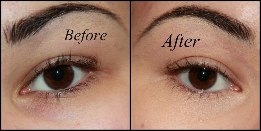 Before After Undereye Circles