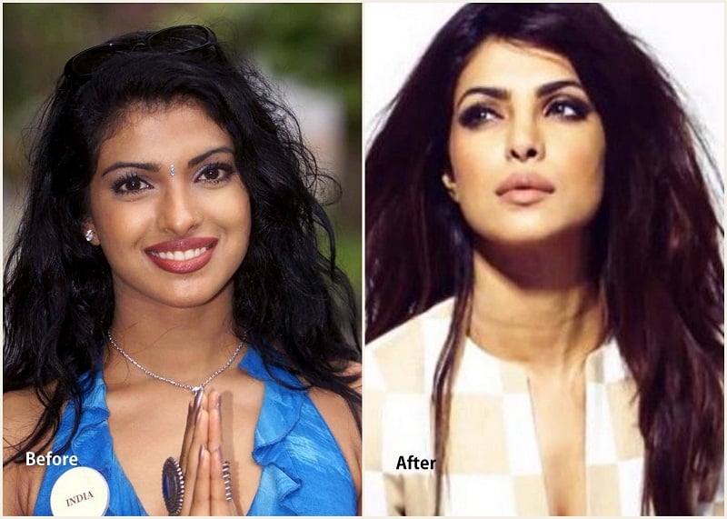 Priyanka Chopra Plastic Surgery