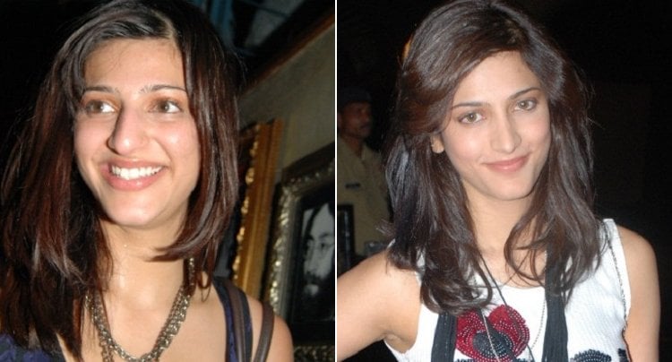 Shruti Hassan Before And After Plastic Surgery