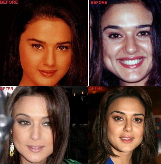 Preity Zinta Plastic Surgery