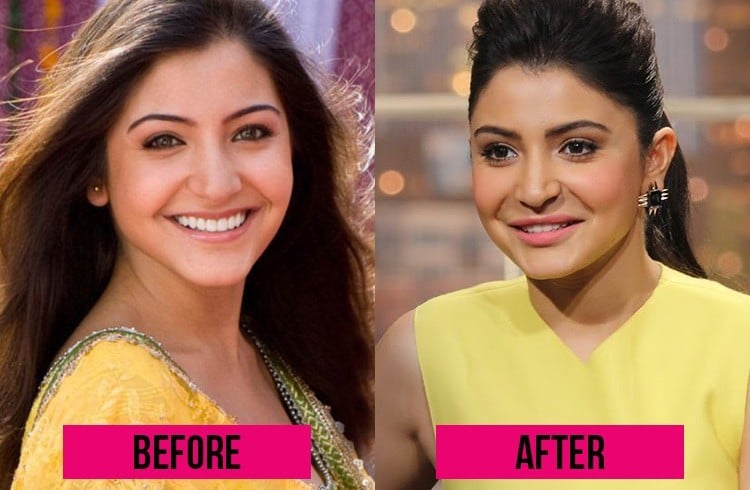 Anushka Sharma lip surgery 