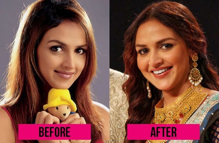 Esha Deol lip job