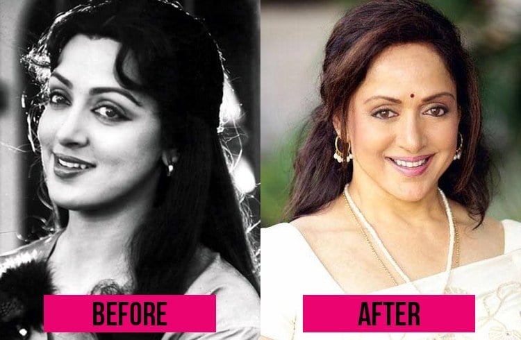 Hema Malini before and after Surgery 