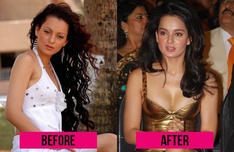 Kangna Ranaut Surgery Failure