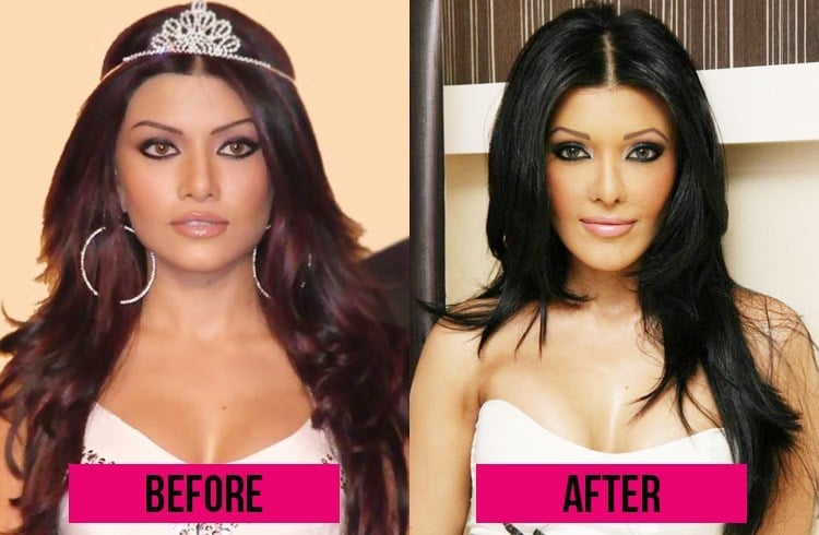 Koena Mitra before and after Surgery