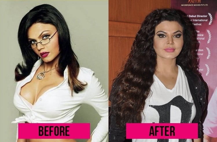 Rakhi Sawant plastic Surgery 