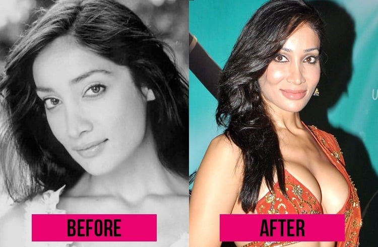 Sofia Hayat Lip Surgery 