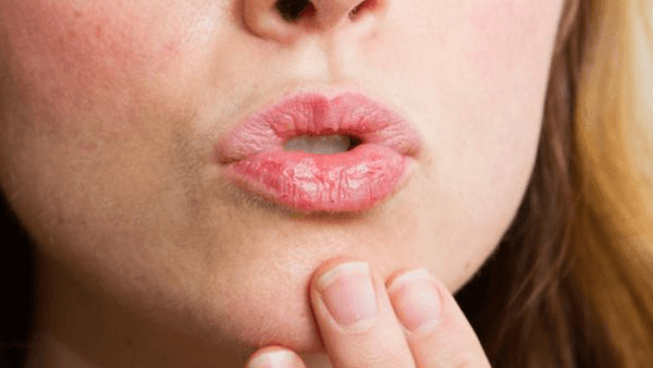 How to Avoid Dry Lips