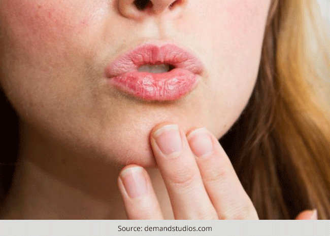 How to Avoid Dry Lips