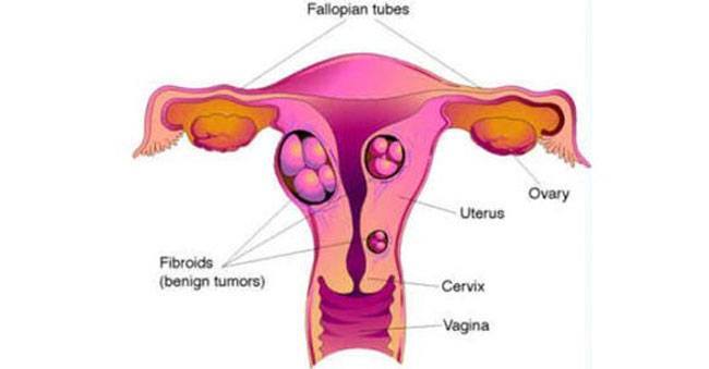 Fibroid