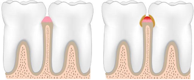 gum disease