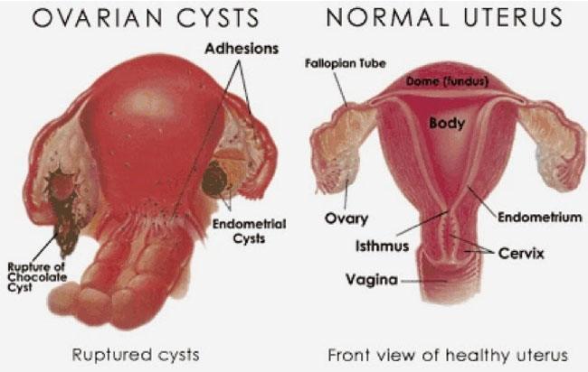 Cysts