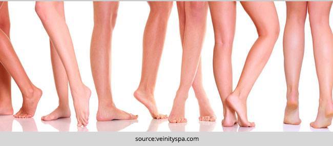 Home remedies to cure Spider Veins