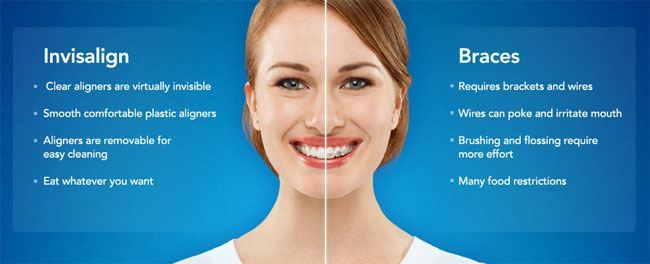 Invisalign