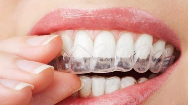 Top 7 Things You should Know about Invisalign