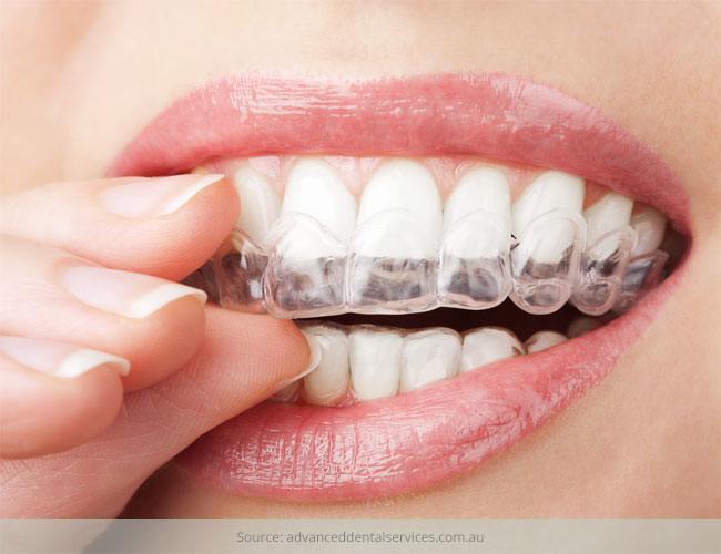Top 7 Things You should Know about Invisalign