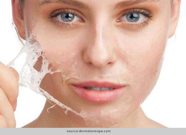 Chemical Peels - Everything You Wanted to Know About it