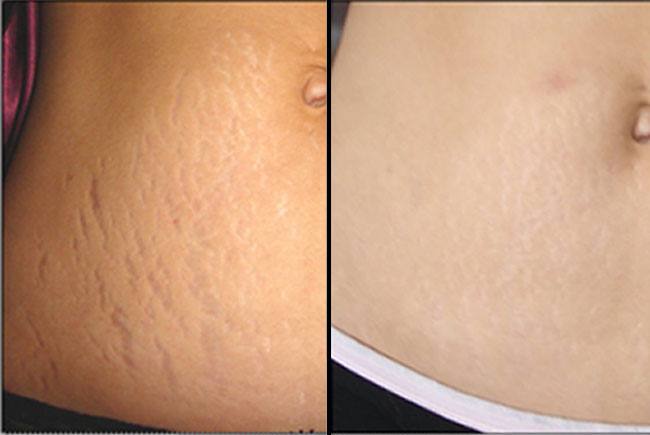 Hide Stretch Marks with Makeup