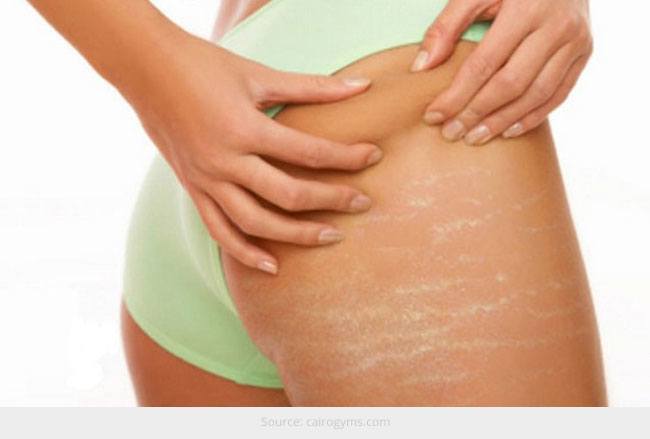 How to Hide Stretch Marks with Makeup