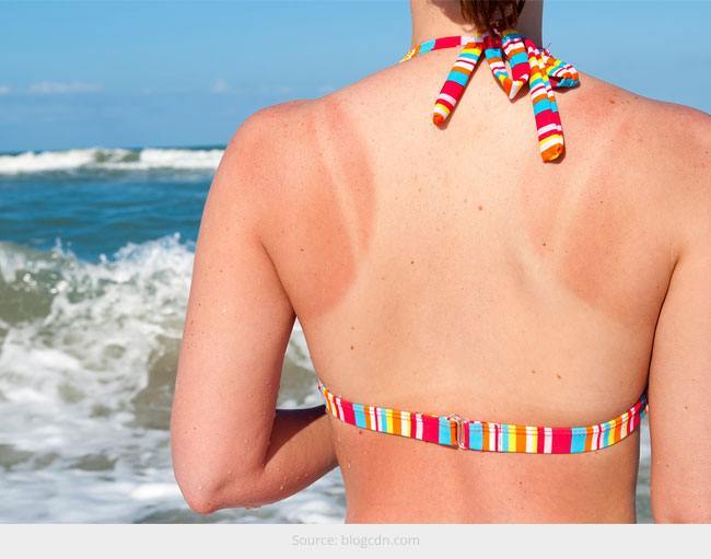 How to Remove Sunburn at Home