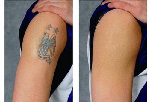 natural tattoo removal