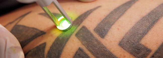 لیزر درمانی برای پاک کردن تاتو