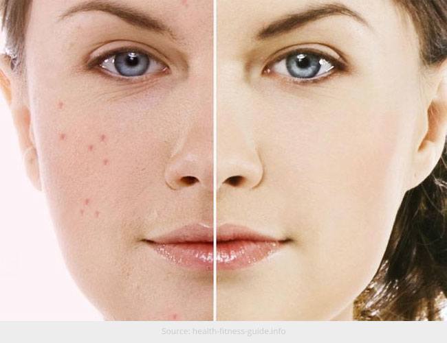 Possible Reasons Your Skin is Prone to Acne