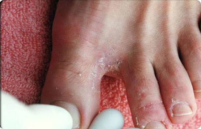 Symptoms of Athlete's foot