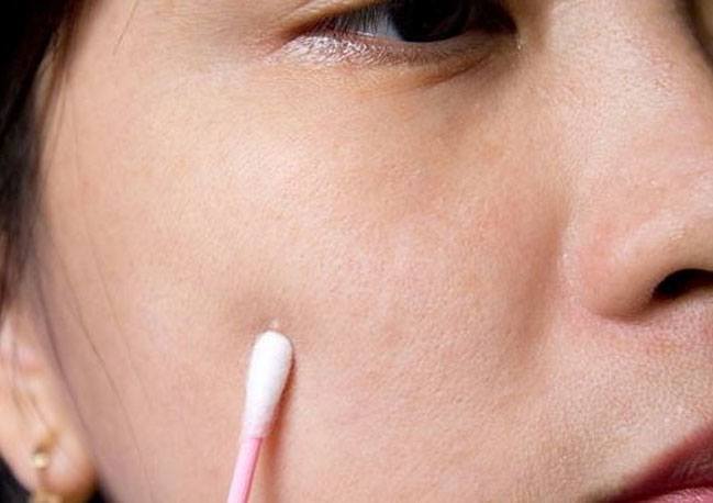 Home Remedies for Whiteheads Home Remedies for Whiteheads