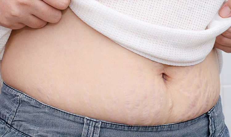 How To Get Rid Of Stretch Marks