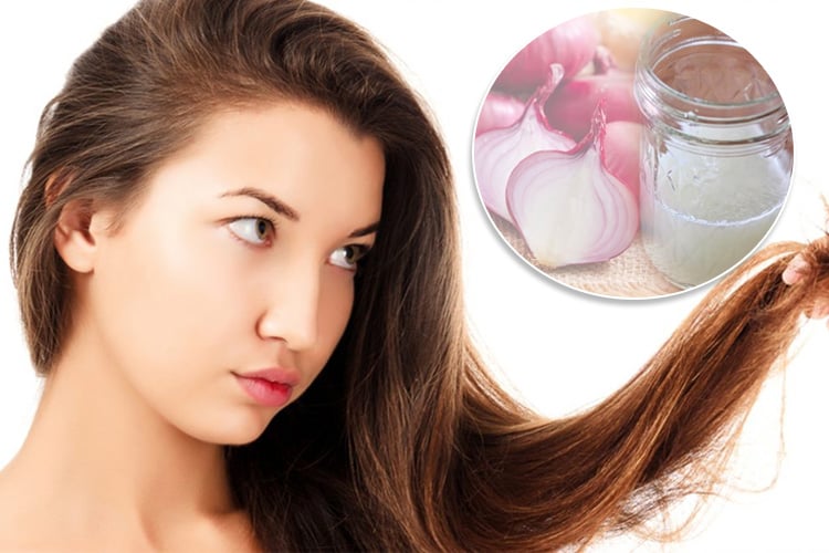14 Best Ways To Use Onion Juice for Hair Problems 14 Best Ways To Use Onion Juice for Hair Problems