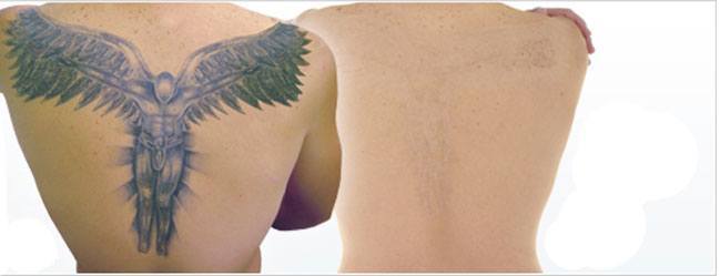 Plastic surgery Tattoo Removal before and after