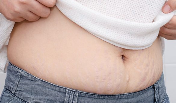 How To Get Rid Of Stretch Marks