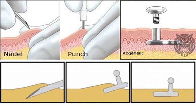 How Dermal Piercing is Done