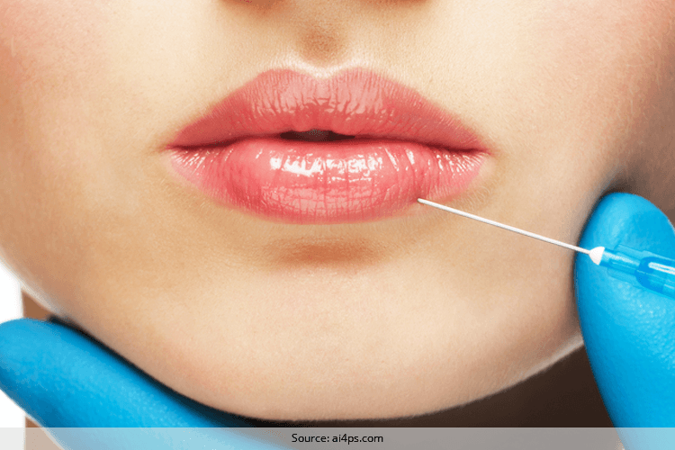 What is Lip Augmentation Should one go for it