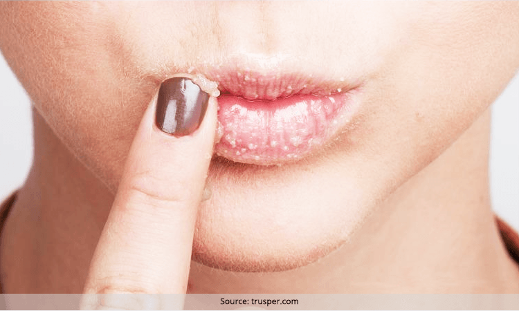 5 DIY Lips Scrubs For Yummylicious Lips like Kylie Jenner