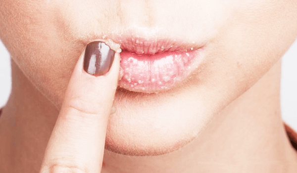 5 DIY Lips Scrubs For Yummylicious Lips