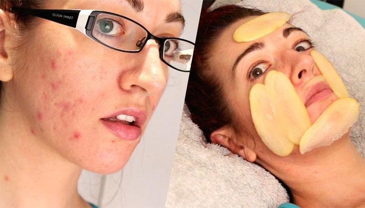 Raw Potato Fighting Acne