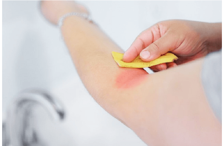 Use Banana Peel for Mosquito and Bug Bites Use Banana Peel for Mosquito and Bug Bites