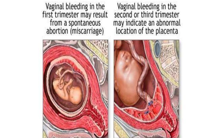 bleeding during pregnancy