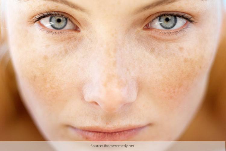 How To Get Rid Of Freckles
