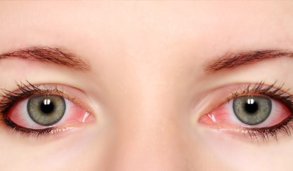 Home Remedies for Pink Eye Treatment