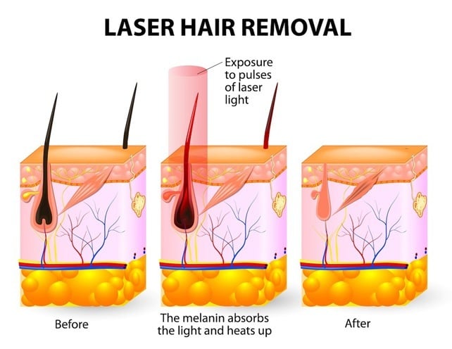 How Laser Hair Removal Works