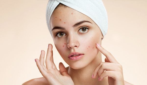 Pimple Treatment For Oily Skin