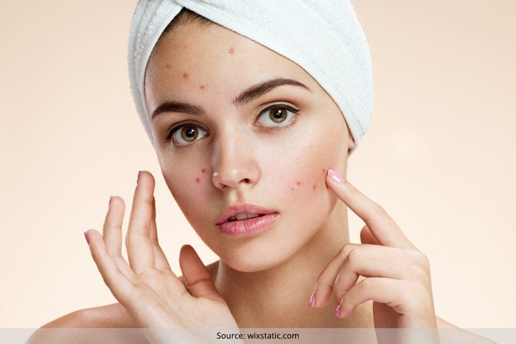  Pimple Treatment For Oily Skin