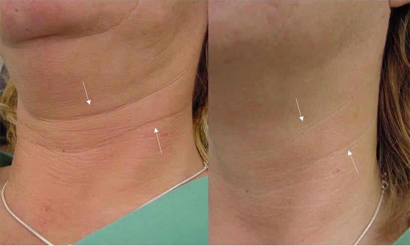 Treatment For Neck Wrinkles